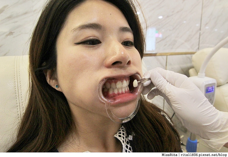 Dr.Min美齒專家 台中美白牙齒 美白牙齒 美齒專家 牙齒美白推薦8
