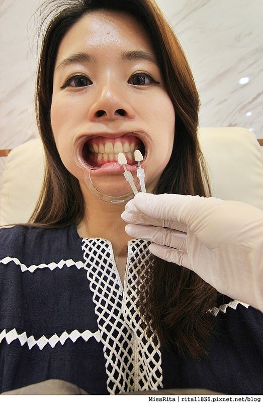 Dr.Min美齒專家 台中美白牙齒 美白牙齒 美齒專家 牙齒美白推薦4