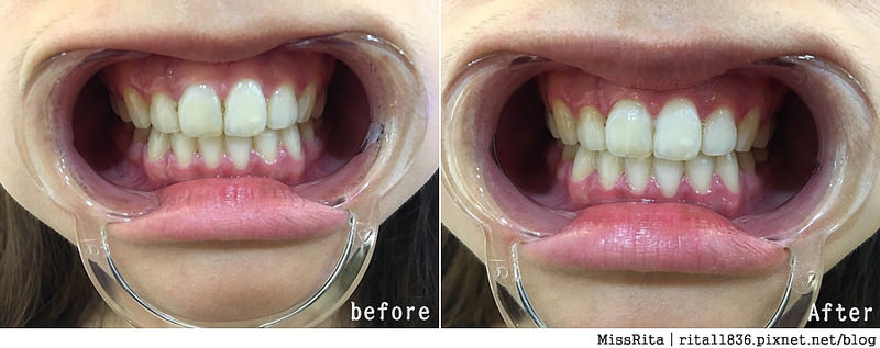 Dr.Min美齒專家 台中美白牙齒 美白牙齒 美齒專家 牙齒美白推薦